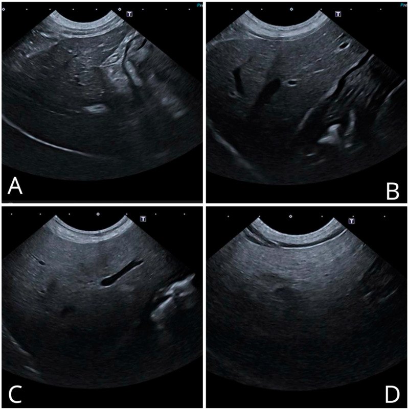 Ultrasound liver grades